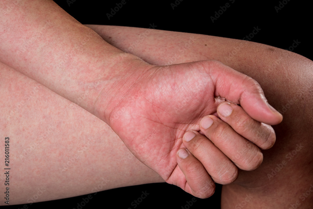 Close up human skin with red rashes from dengue disease Close up human skin with red rashes from dengue disease
