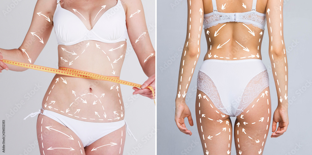 Cellulite removal arrow scheme. White markings young on body woman plastic  surgery set. Stock Photo