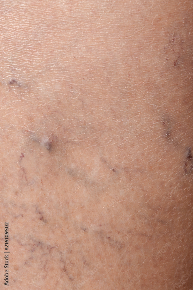 Woman's leg with varicose veins, closeup