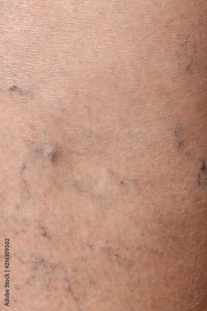 Fototapeta premium Woman's leg with varicose veins, closeup