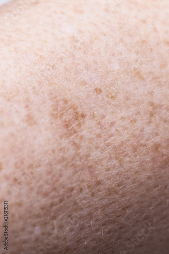 Skin complexion discoloration, hyperpigmentation close up photo