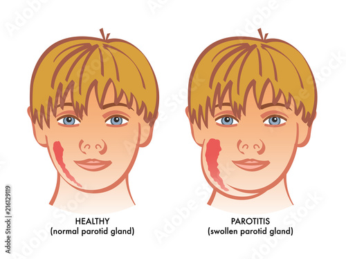 A vector medical illustration showing a healthy child next to on suffering from parotitis or inflammation of parotid glands. photo