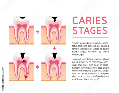Tooth on different stages of dental caries development. Enamel caries, Dentin caries, Pulpitis and Periodontitis. Design for banner and poster. Illustration on white background.
