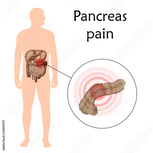 Pancreas pain, inflammation, pancreatitis. Anatomy vector realistic illustration. White background.