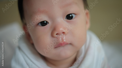 The Asian boy have the flu with having a runny nose.