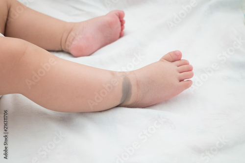 The little feet with birthmark. This birthmark will disappear in the future. (Called Mongolian spot)