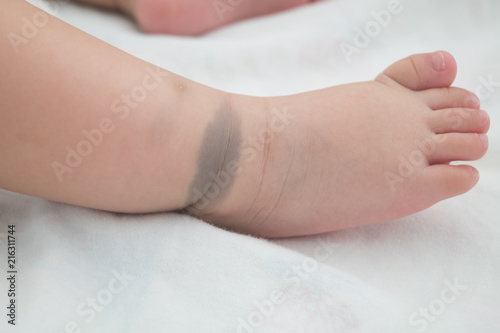 The little foot with birthmark. This birthmark will disappear in the future. (Called Mongolian spot)