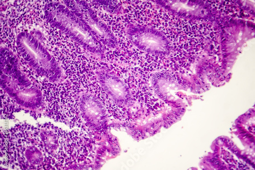 Suppurative appendicitis, light micrograph, photo under microscope showing neutrophilic infiltrates of the appendix wall
