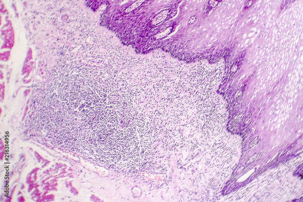 Squamous Cell Carcinoma, Light Micrograph, Photo Under Microscope Stock 