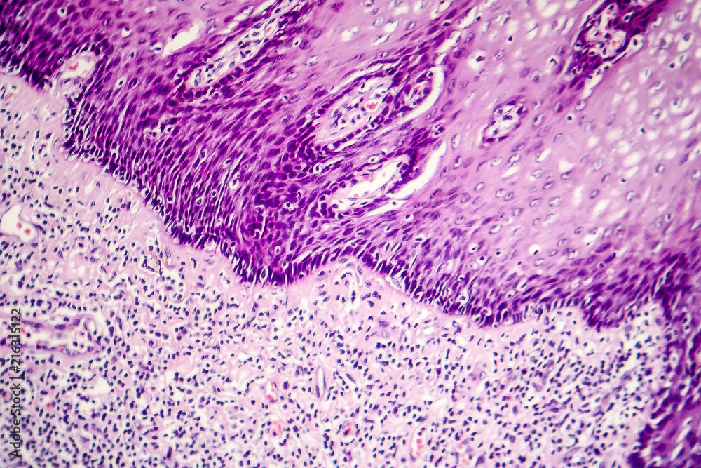 Squamous Cell Microscope Squamous cell carcinoma, light micrograph, photo under microscope Stock ...