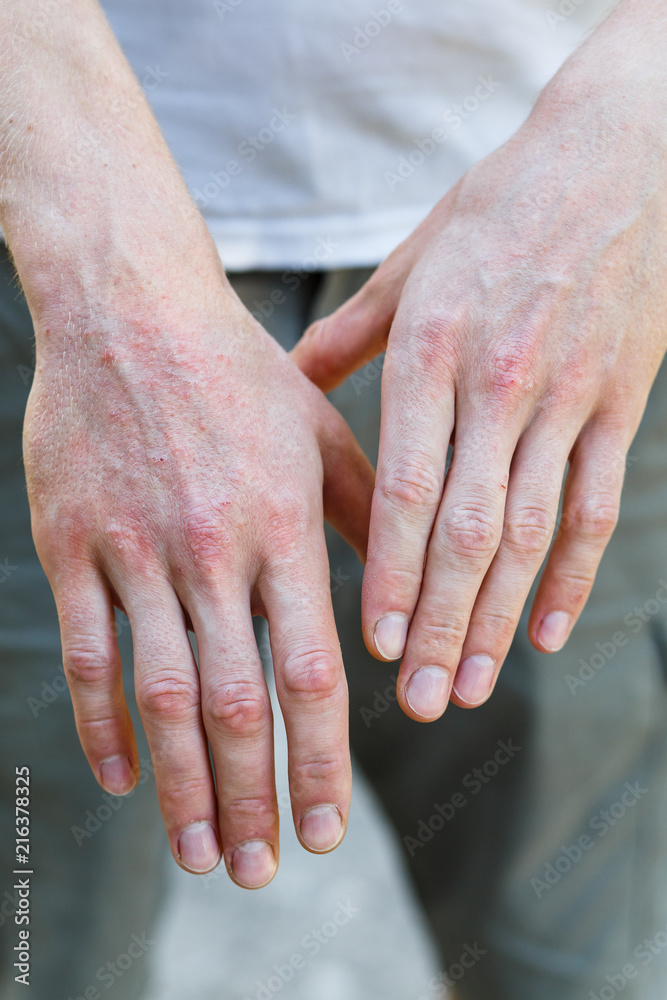 Psoriasis vulgaris on the mans hands with plaque, rash and patches on