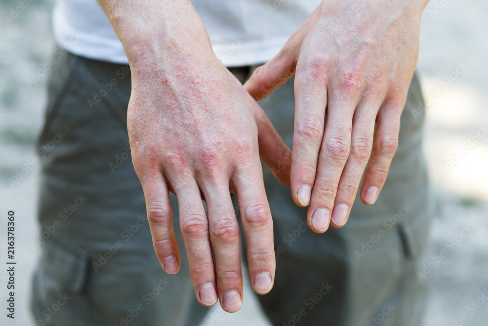 Psoriasis vulgaris on the mans hands with plaque, rash and patches on skin. Autoimmune genetic disease. Close up view. Horisontal photo