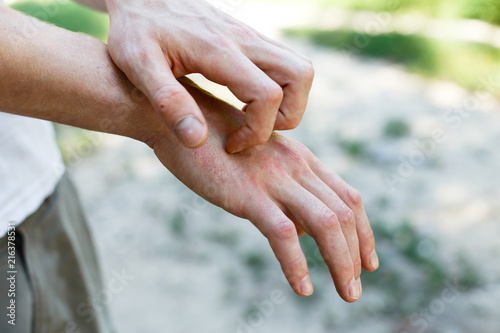 The problem of many people - eczema on hand. Street background. Man itchind psoriasis skin with red rashes and spots