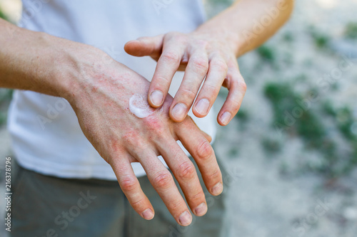Ointment on hand. Applying the ointment in the treatment and hydration of the skin.Psoriasis skin. Horizontal photo photo