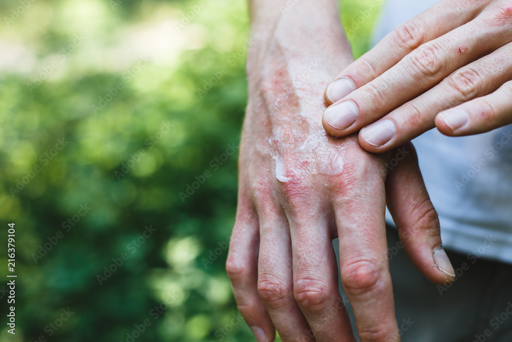 Ointment on hand. Applying the ointment in the treatment and hydration of the skin.Psoriasis skin. Horizontal photo. Copy space on green background Ointment on hand. Applying the ointment in the treatment and hydration of the skin.Psoriasis skin. Horizontal photo. Copy space on green background