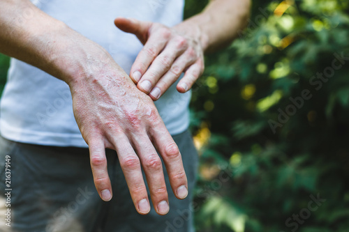 Ointment on hand. Applying the ointment in the treatment and hydration of the skin.Psoriasis skin. Horizontal photo photo