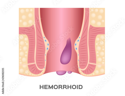 Hemorrhoids stage vector. ass and anus