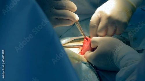 Surgeons are making an ostium in an organ during operation photo