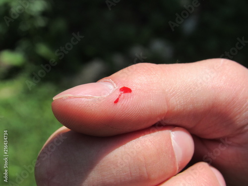 A person with a drop of blood on their thumb from a cat attack 