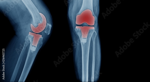 X-ray image, total knee artroplasty in blue tone photo
