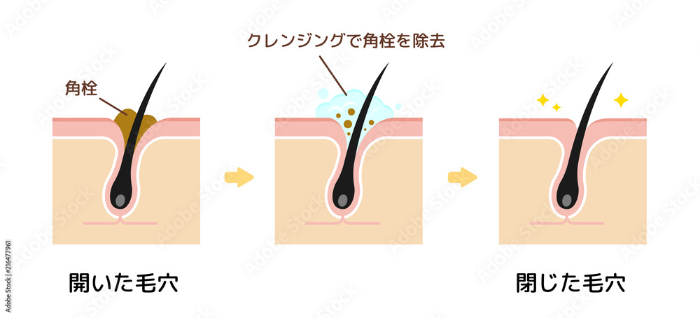 毛穴断面図イラスト 角栓 皮脂汚れの詰まった毛穴をクレンジングできれいにする様子 Stock Vector Adobe Stock