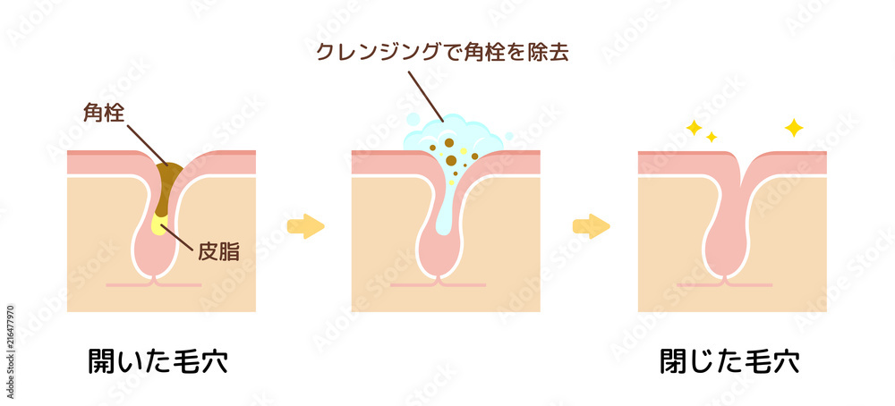 毛穴断面図イラスト 角栓 皮脂汚れの詰まった毛穴をクレンジングできれいにする様子 Stock Vector Adobe Stock