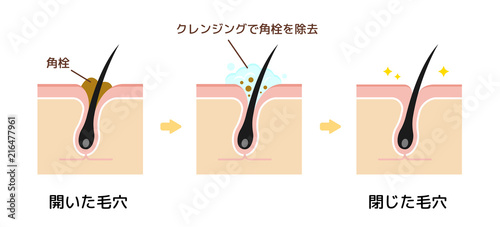 毛穴断面図イラスト / 角栓・皮脂汚れの詰まった毛穴をクレンジングできれいにする様子