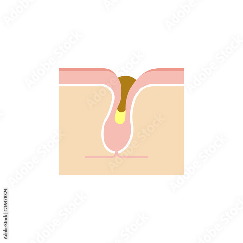 Structure illustration of pores /keratotic plug (whiteheads , blackheads) . 