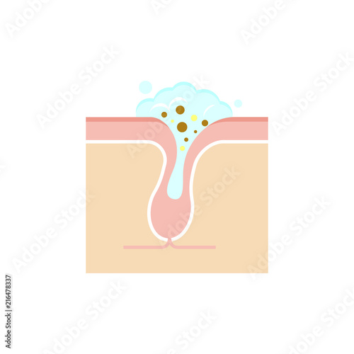 Structure illustration of pores /cleansing, clear keratotic plug (whitehead). 