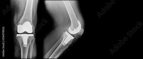 TKA x-ray, total knee replacement frontal and lateral view