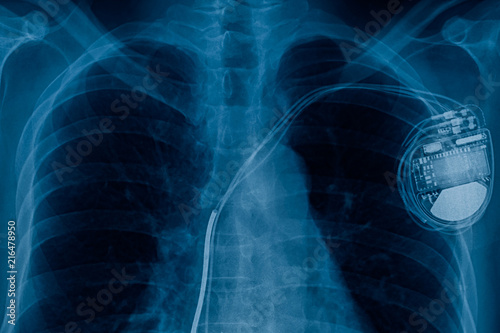 pacemaker cell x-ray image photo