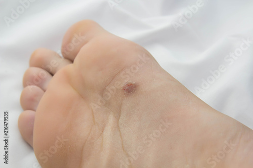 foot with problem areas on the skin.close up