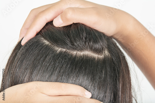 Long and thick hair of women and scalp problem and dandruff