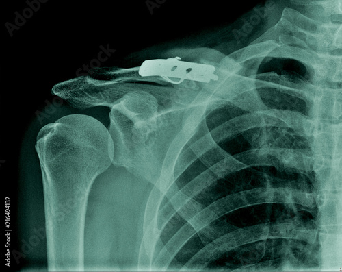 Bild auf Leinwand x-ray clavicle fracture with post operation fixation