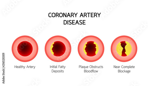 Coronary Artery Disease infographic. Heart awareness concept. Atherosclerosis stages in artery caused by cholesterol plaque. Vector illustration isolated on white background. photo