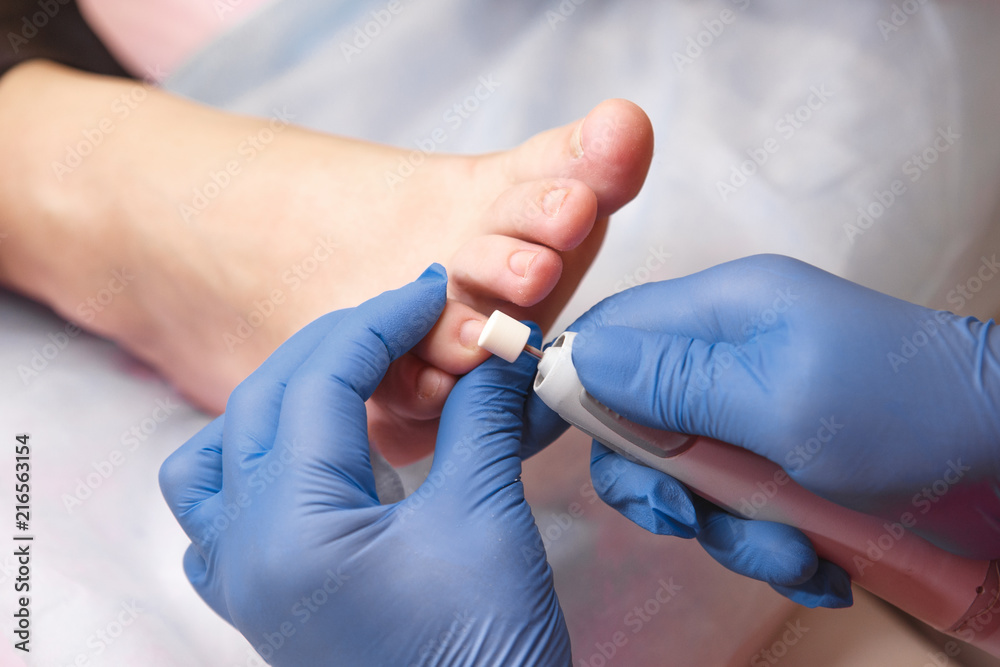 Podology treatment. Podiatrist treating toenail fungus. Doctor removes calluses, corns and treats ingrown nail. Hardware manicure. Health, body care concept. Selective focus. - obrazy, fototapety, plakaty 