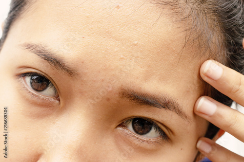 Foto Forehead that is wrinkled and acne of woman.