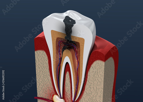 Foto Tooth decay. 3D illustration