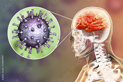Varicella zoster virus VZV encephalitis, medical concept, 3D illustration showing brain infection and close-up view of VZV in the brain. Encephalitis is one of complications of chickenpox photo