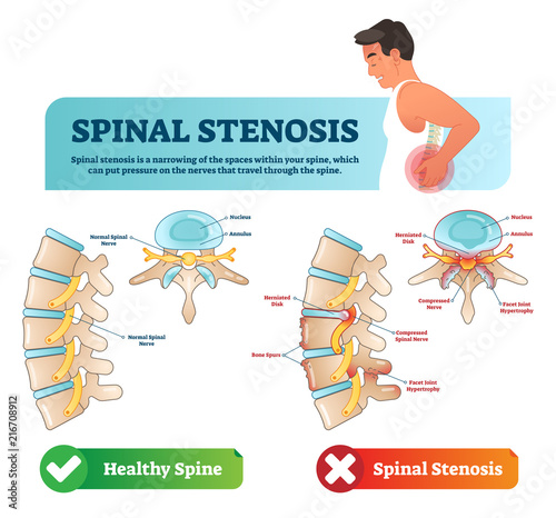 Spinal stenosis vector illustration. Labeled medical scheme with explanation. Diagram with normal spinal nerve, nucleus, annulus, bone spurs and compressed spinal nerve. photo