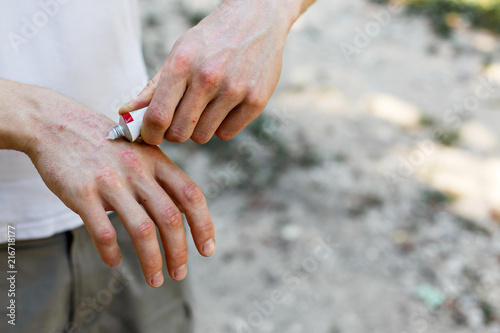 applying an emollient to dry flaky skin as in the treatment of psoriasis, eczema and other dry skin conditions. White cream on skin photo