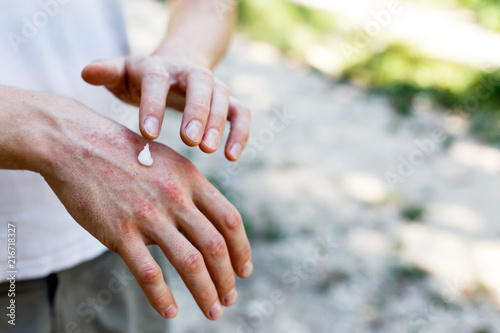 applying an emollient to dry flaky skin as in the treatment of psoriasis, eczema and other dry skin conditions. White cream on skin