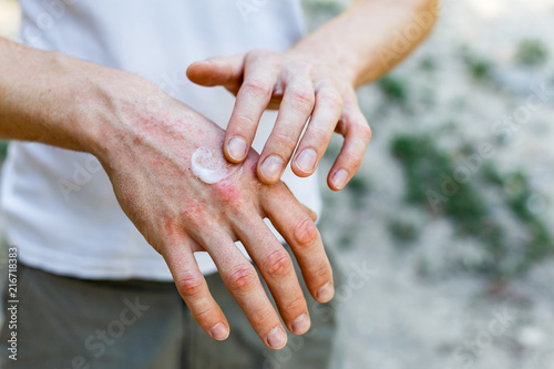 applying an emollient to dry flaky skin as in the treatment of psoriasis, eczema and other dry skin conditions. White cream on skin photo