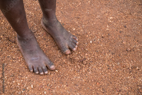Poverty Child Feet in Africa