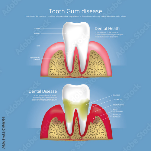 Human teeth Stages of Gum Disease Vector Illustration