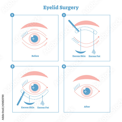 Eyelid surgery procedure scheme illustration. Excess skin and fat removal plastic surgery. Women fashion and beauty informative material with modern simple line style design.