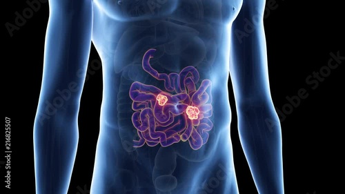 medically accurate 3d animation of bowel cancer photo