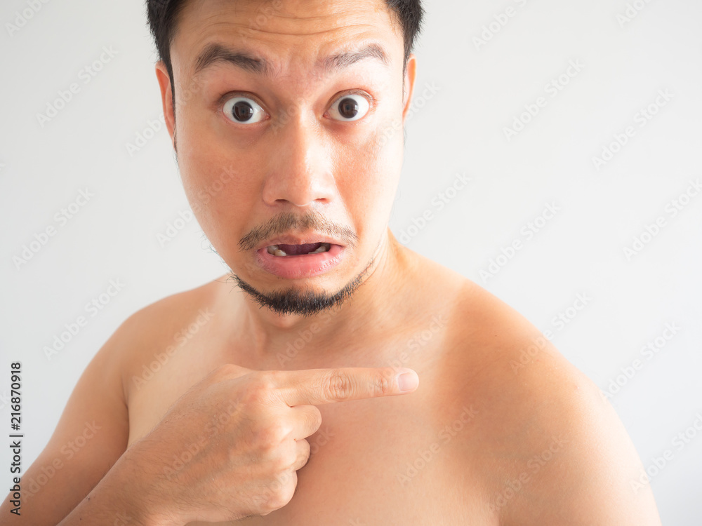 Asian man get ugly tanned on the shoulder Stock Photo | Adobe Stock