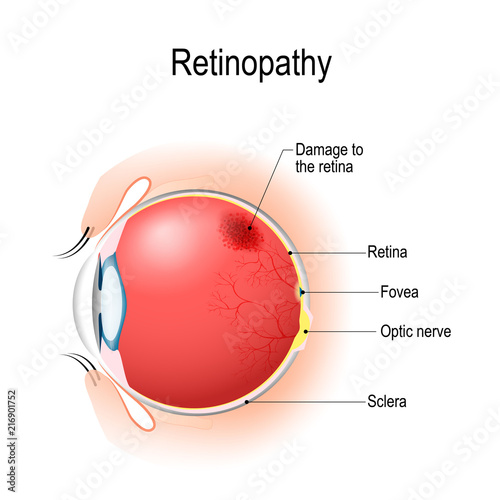 Retinopathy. Vertical section of the eye and eyelids with damage to the retina.