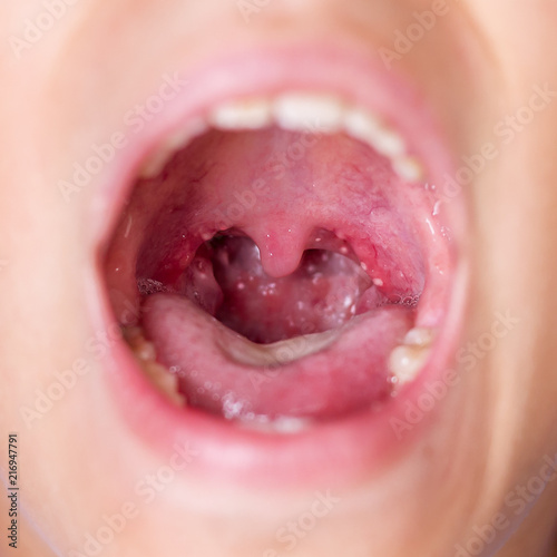 Coxsackie virus in a child. Variety of enterorovirus, herpangina